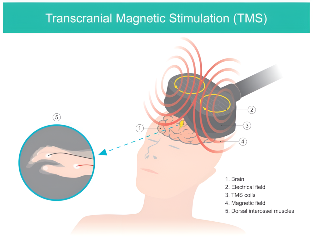 Conditions Treated with TMS Therapy